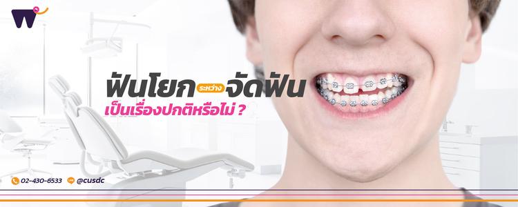 ฟันโยก ระหว่าง จัดฟัน เป็นเรื่องปกติหรือไม่? กลไกการเคลื่อนตัวของฟัน