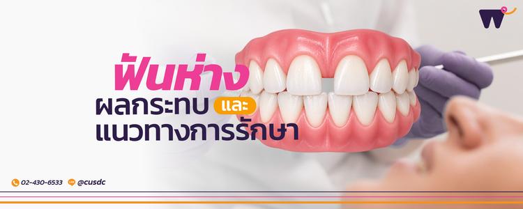 ฟันห่าง จุดเล็กๆ ที่ทำลายความมั่นใจ: ผลกระทบ และแนวทางการรักษา